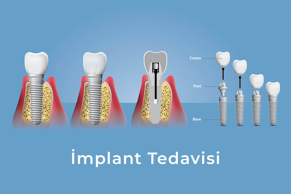gaziantep implant